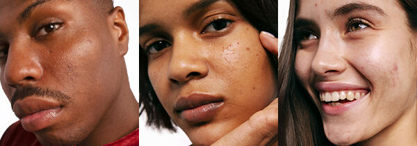 Curare l&rsquo;acne: routine di bellezza da seguire