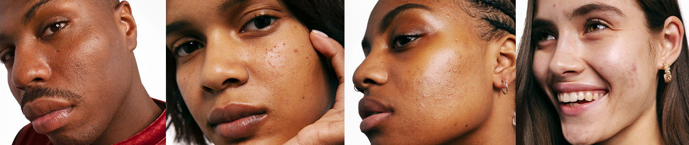 Curare l&rsquo;acne: routine di bellezza da seguire